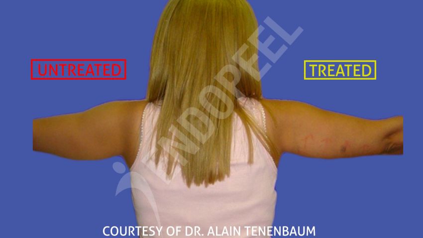 arm-lift-slide-32.jpg