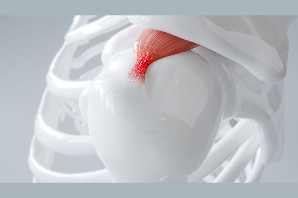 shoulder-tendinitis