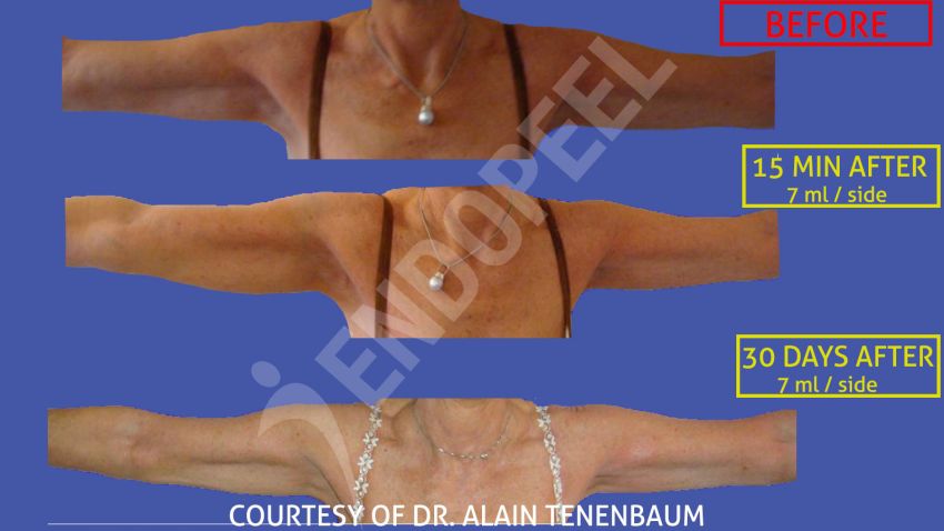 arm-lift-slide-4.jpg