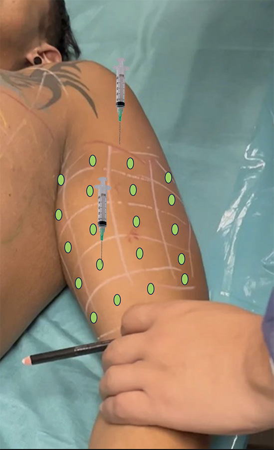 Step6-vectors-syringe