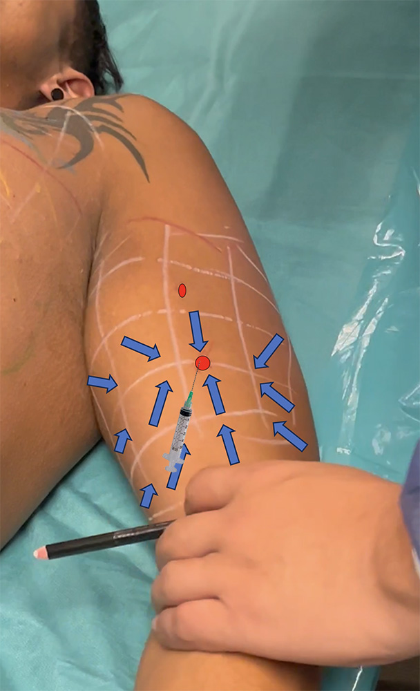 Step7-marking-Tensors
