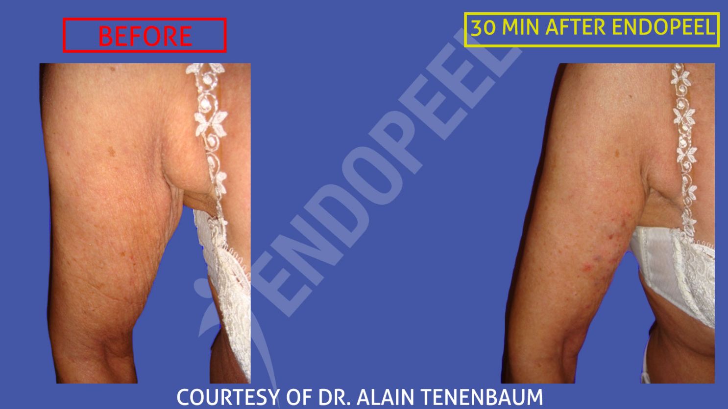 retensado cutaneo brazos endopeel