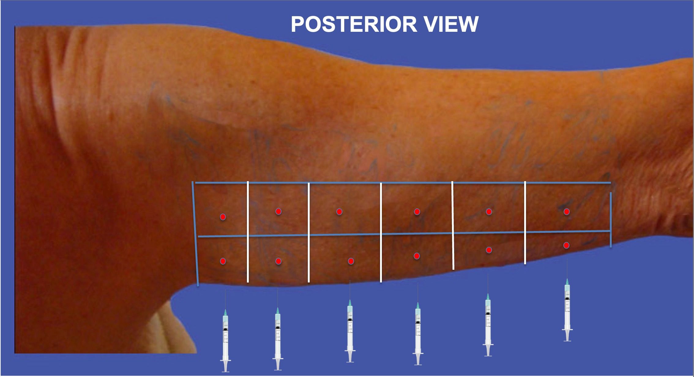 lower-edge-injections--posterior view