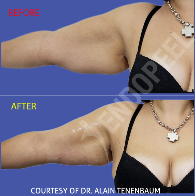 arm-lift-endopeel-right-side-anterior-view