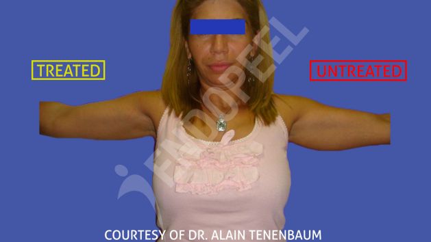 Comparaison of untreated and treated arm with endopeel