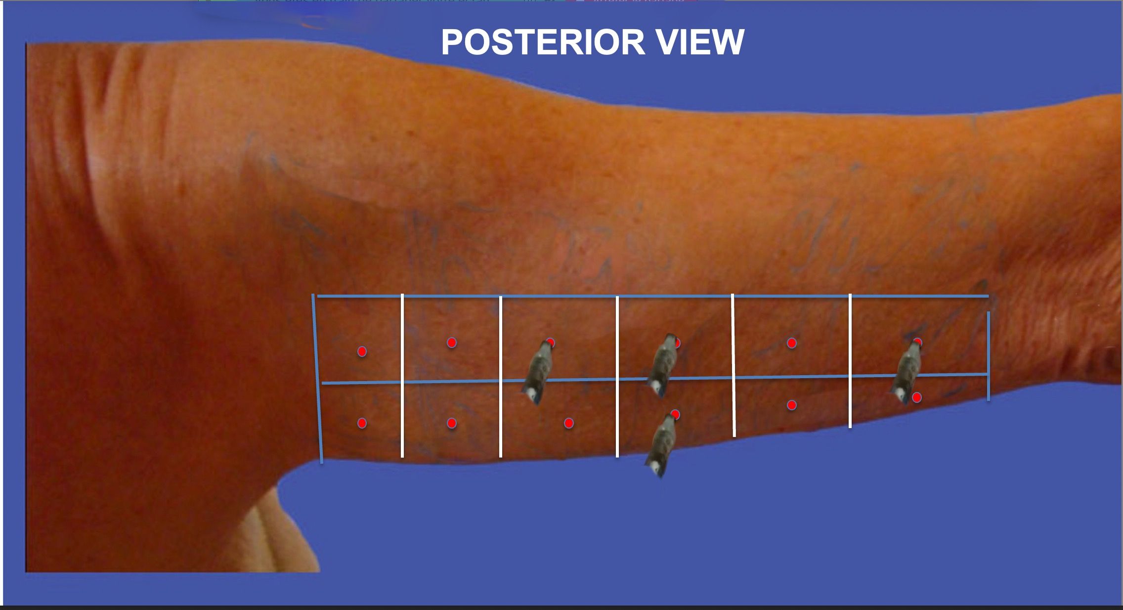 vectors-posterior-injections
