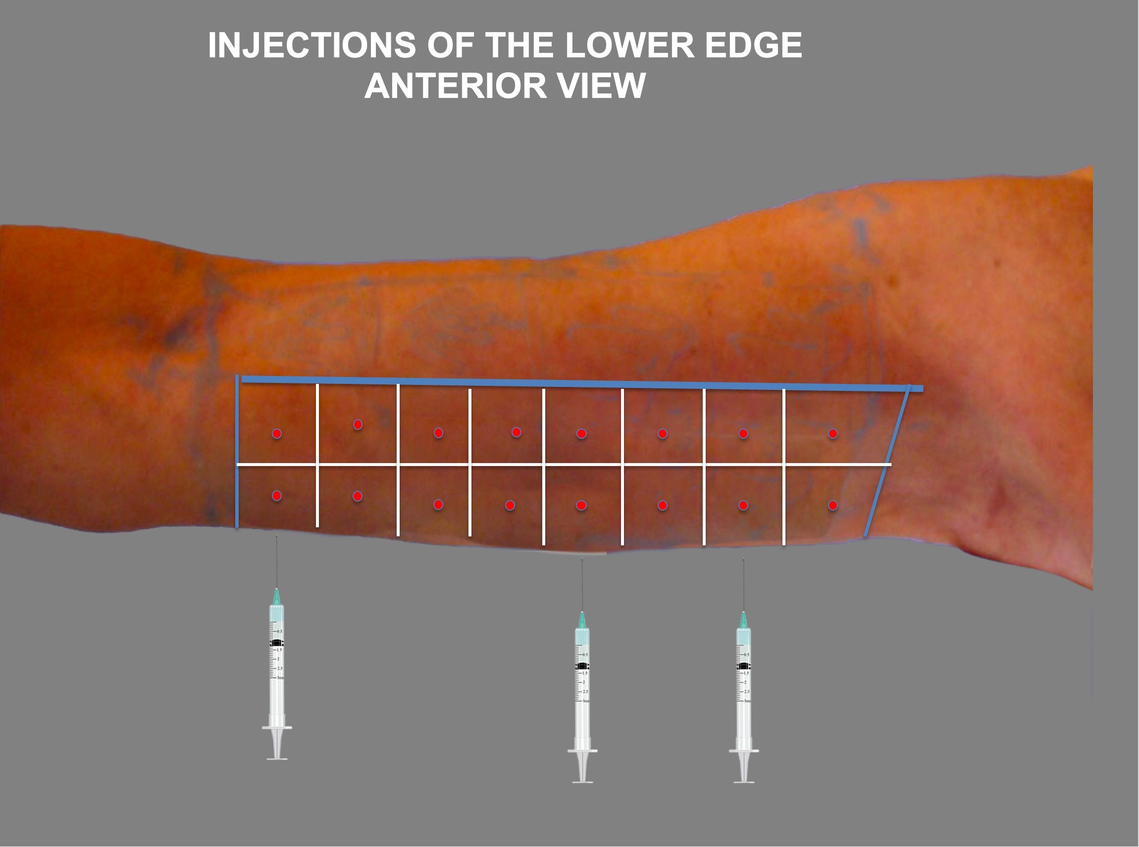 tensors-anterior-injections