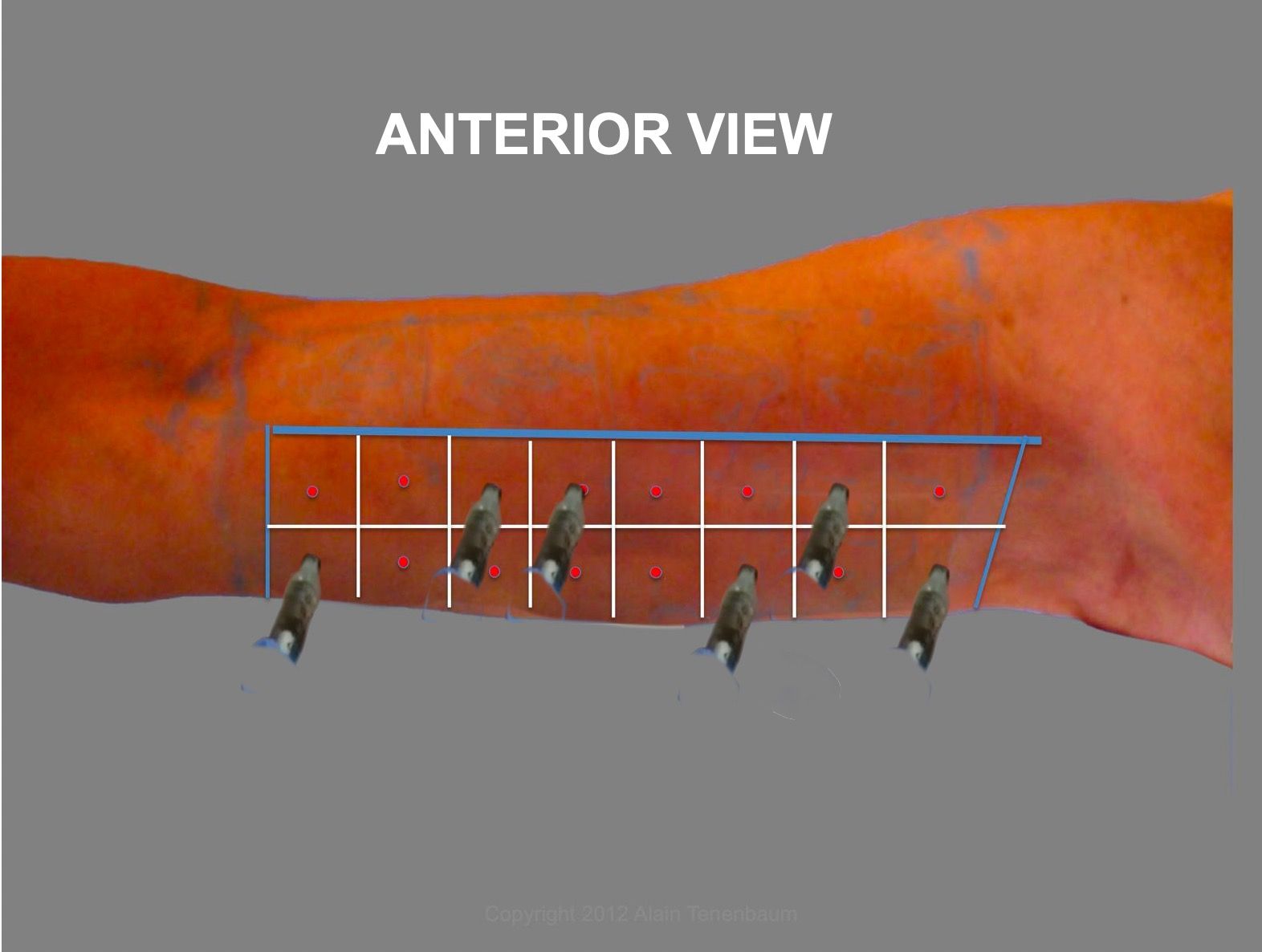 vectors-anterior-injections