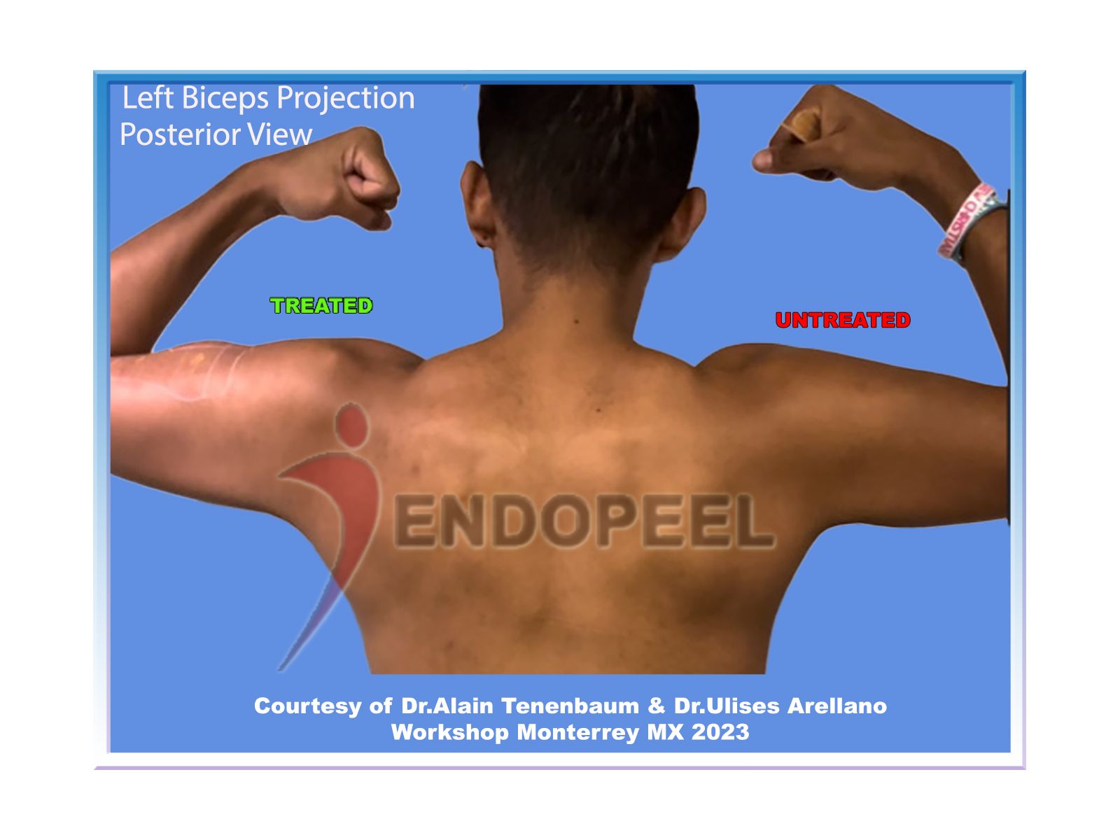 left-biceps-projection-posterior