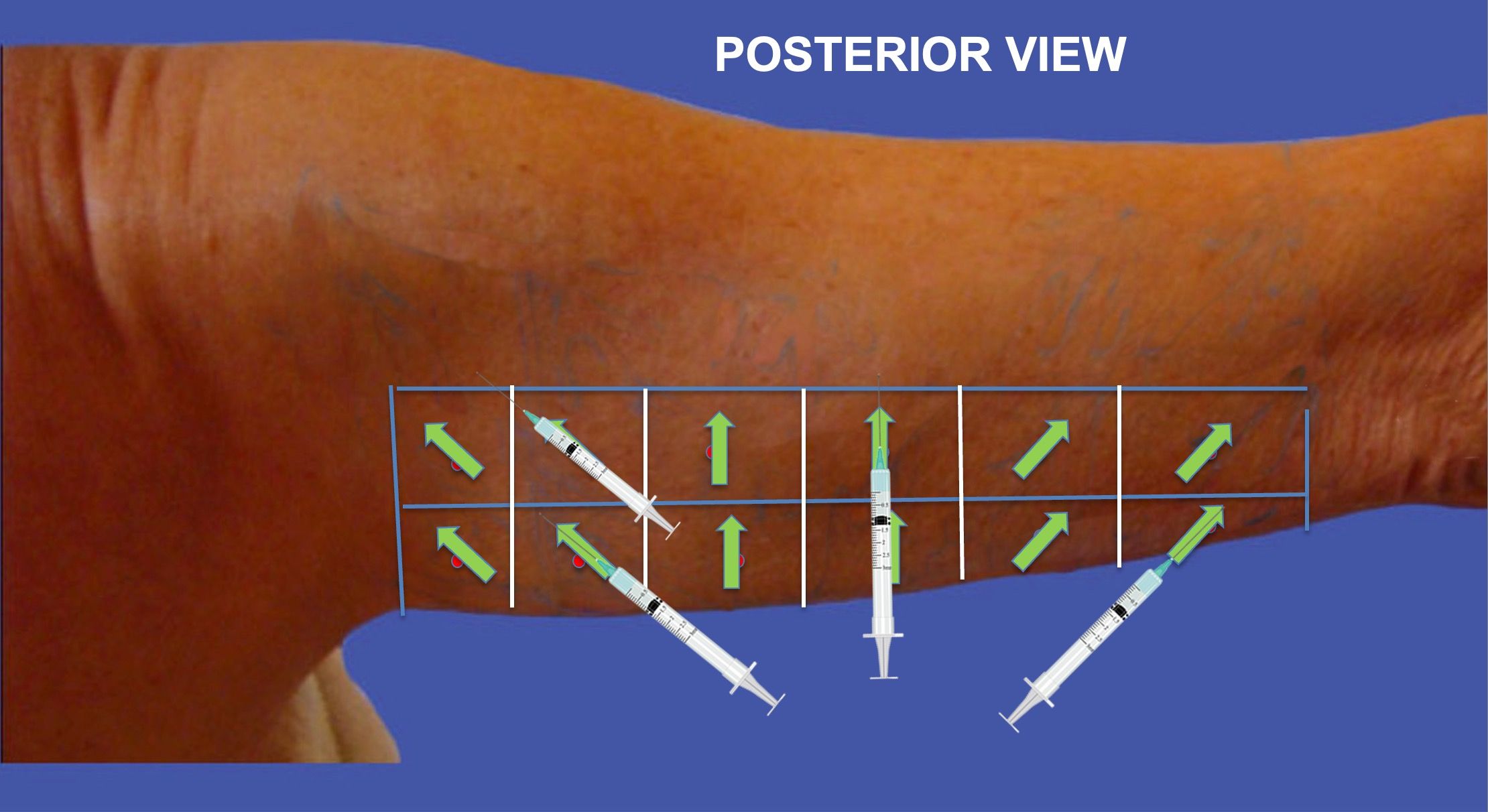 tensors-posterior-injections