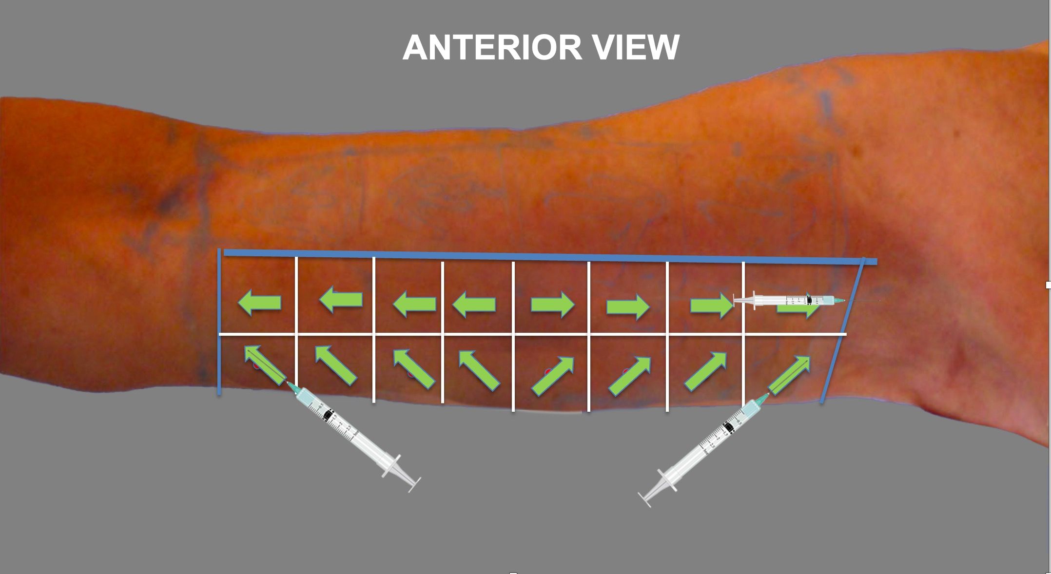 tensors-anterior-injections