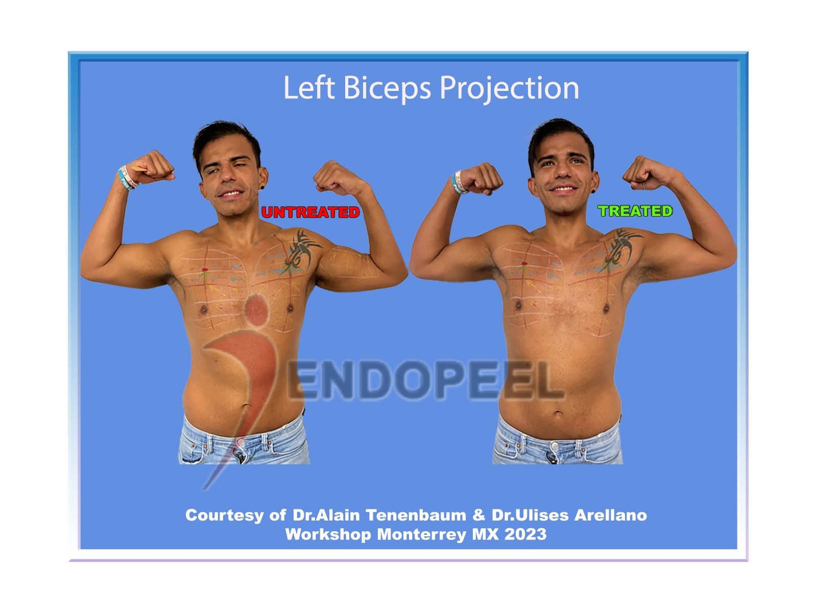 left-biceps-projection-anterior-view